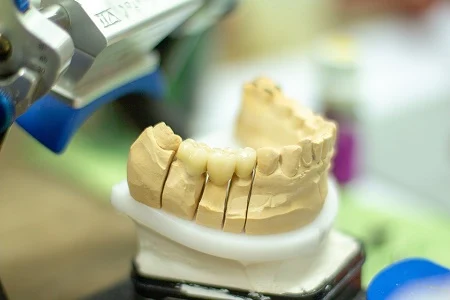 Ponte dentale in lavorazione su modello in gesso, Odonto FMS Torino